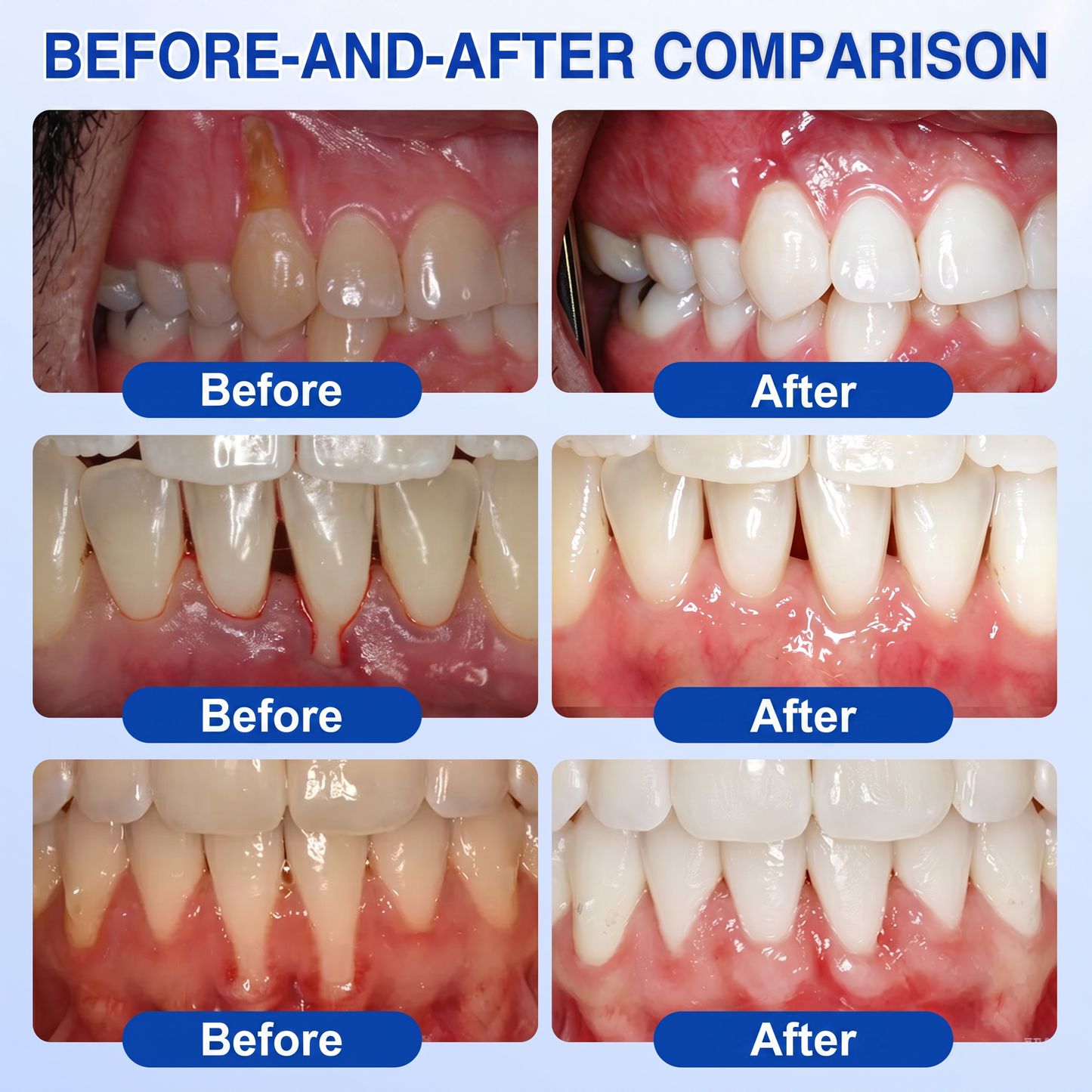 Pureluxo® 🦷GumRevive periodontal repair gel🌿