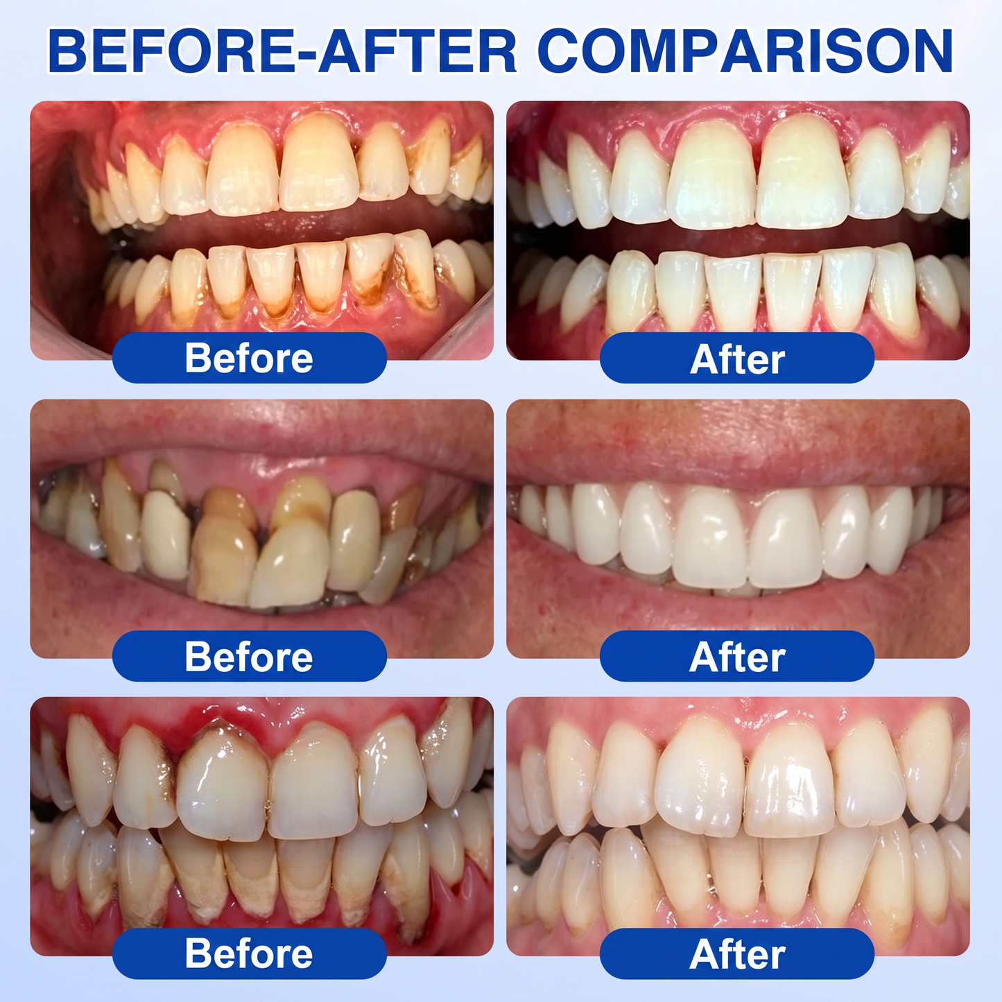 Pureluxo® 🦷GumRevive periodontal repair gel🌿