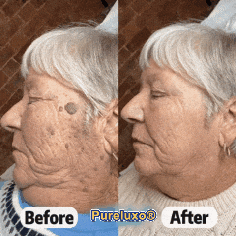 Pureluxo® Skin Tag Remover Roller💥