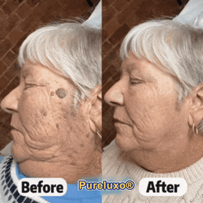 Pureluxo® Skin Tag Remover Roller💥