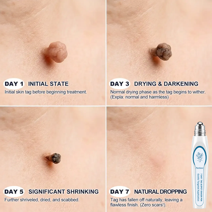 Pureluxo® Skin Tag Remover Roller💥